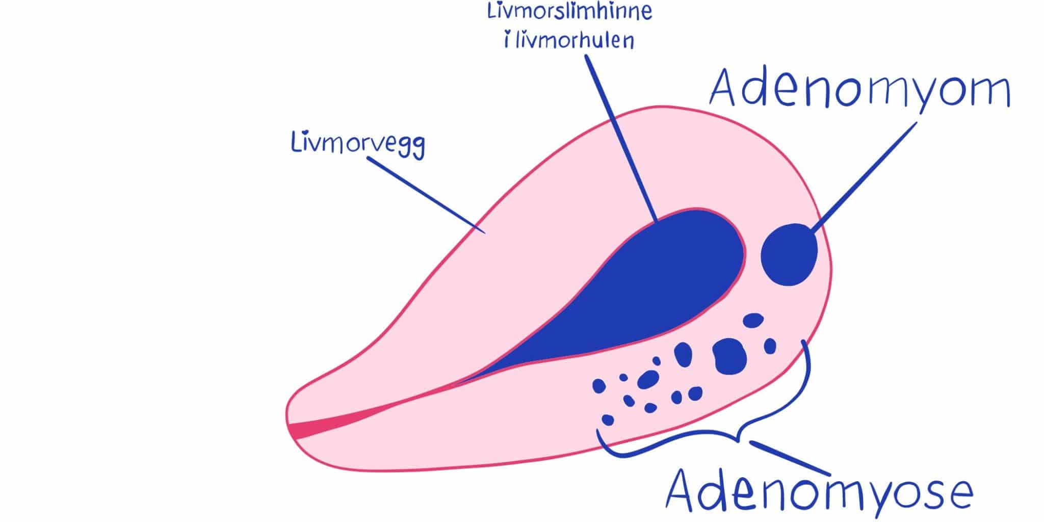 Adenomyose | Endometrioseforeningen i Norge