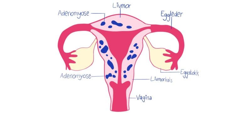 Illustrasjon av en livmor med adenomyoseflekker